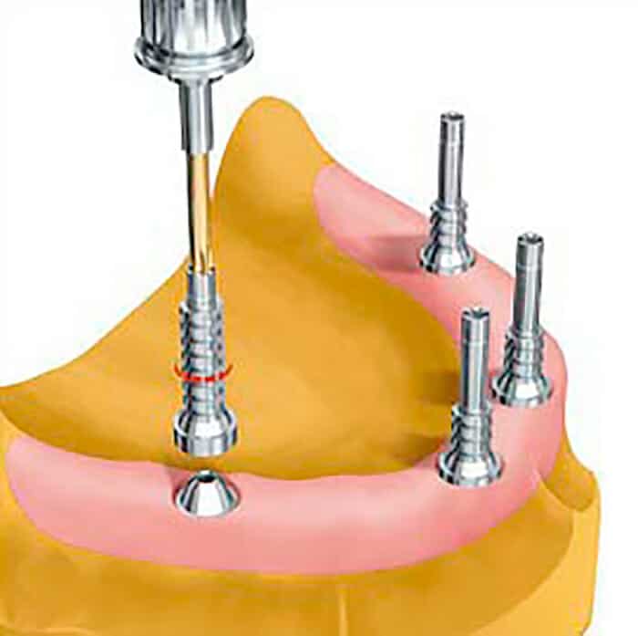 Multi-unit tooth prosthesis with ti cylinder