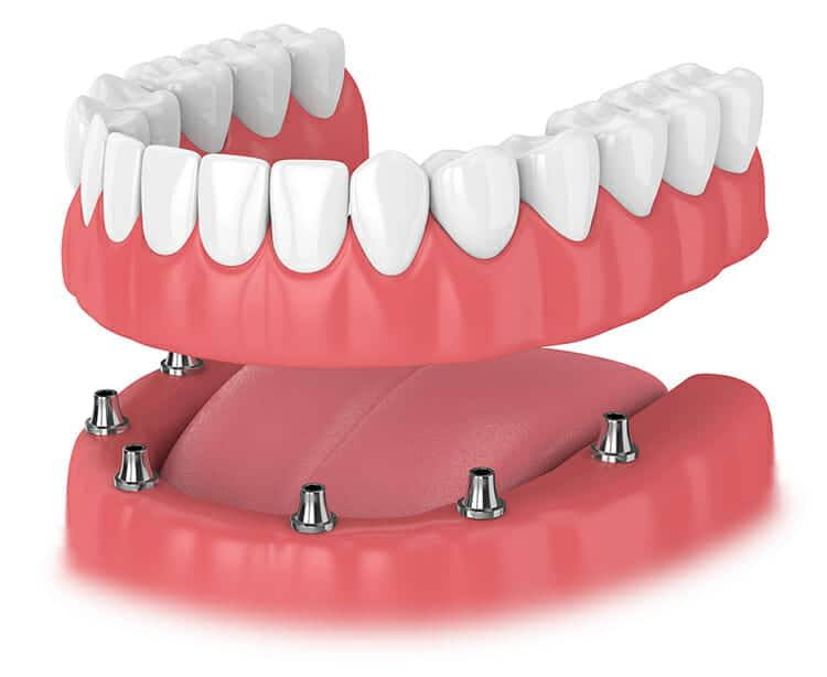 Implant Dentures from Burbank Dental Lab