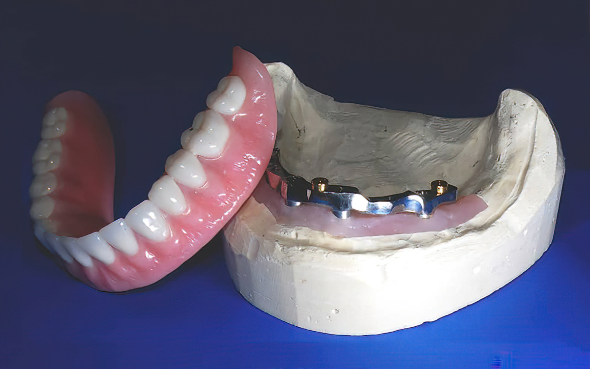 When To Choose SMART 1 Implant Bar-Supported Dentures - Burbank Dental Lab - A California Dental Lab