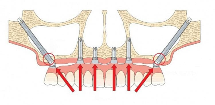 Zygomatic Implant Applications - Dr. Joel Defrancq