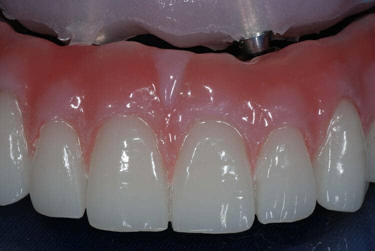 Burbank Dental Lab Hybrid Denture Prosthetics