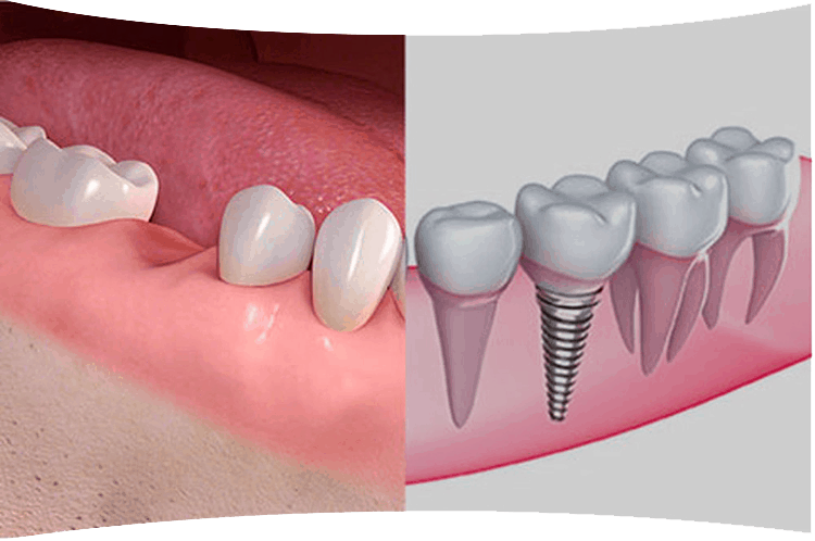 Comprehensive Single/Quadrant Implant Workflow