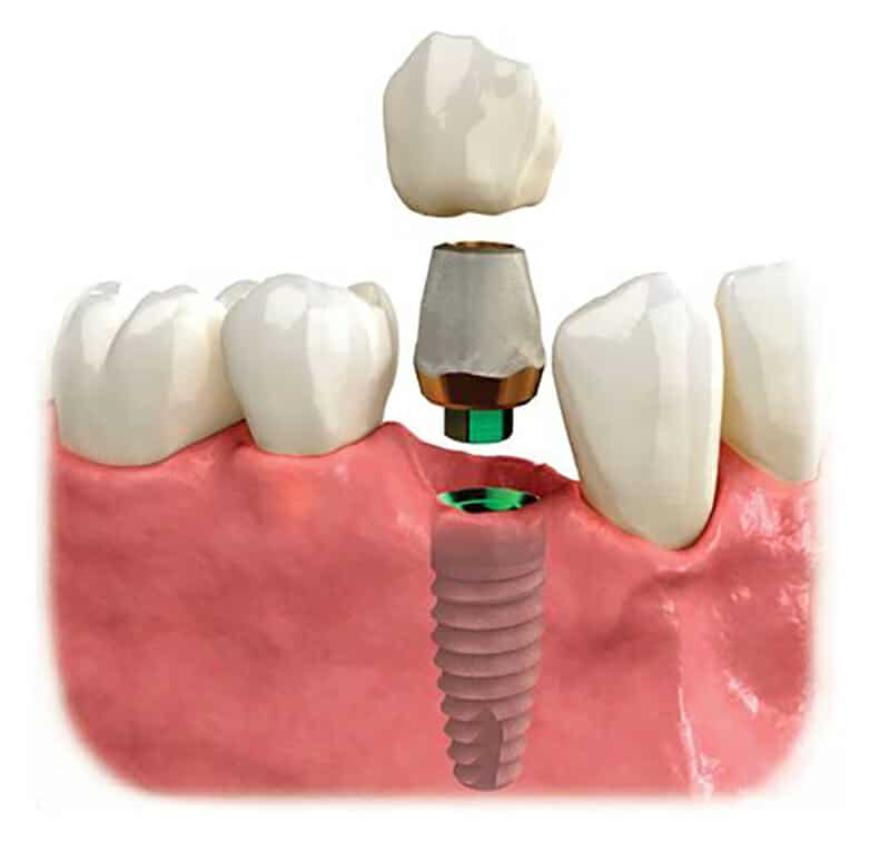 Restoration / Abutments - Fig. 10