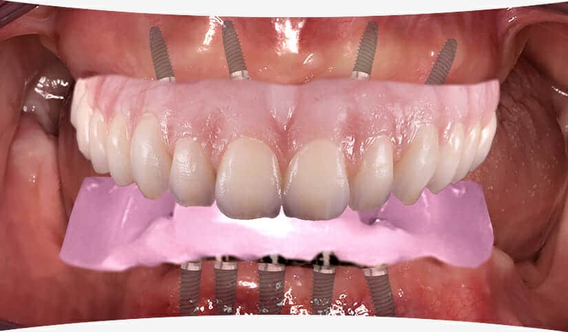 The Traditional Workflow for Edentulous Implant Cases