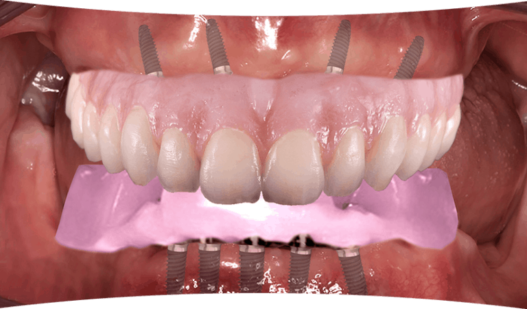 The Traditional Workflow For Edentulous Implant Cases - Burbank Dental