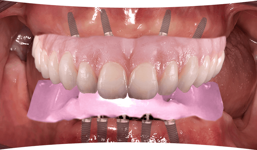 The Traditional Workflow for Edentulous Implant Cases