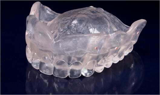 Duplicate of current denture - Figure 1