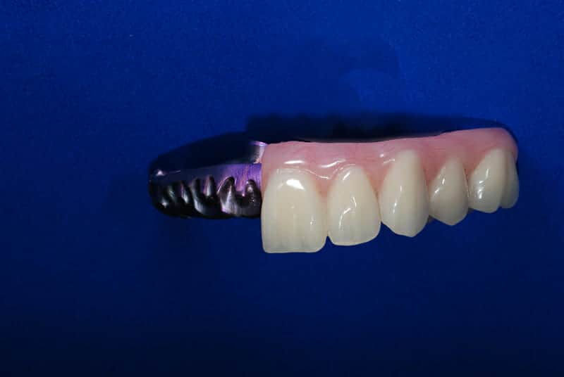 Acrylic and denture teeth cured to a metal structure