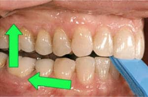 Occlusal Guards And Splints - Burbank Dental Lab