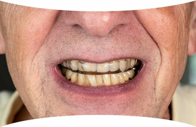 Guarding Occlusion Basic Principles Burbank Dental Lab