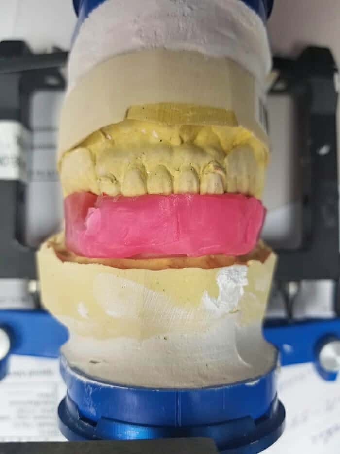 New denture set-up