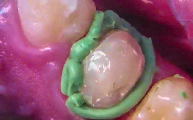 Using gingival retraction clay
