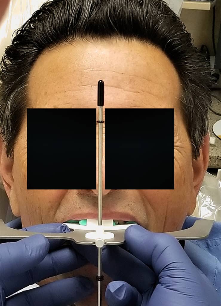 Using a Lois Facial Analyzer Facebow - Burbank Dental Lab