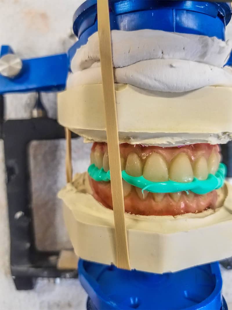 Mount lower to conversion denture