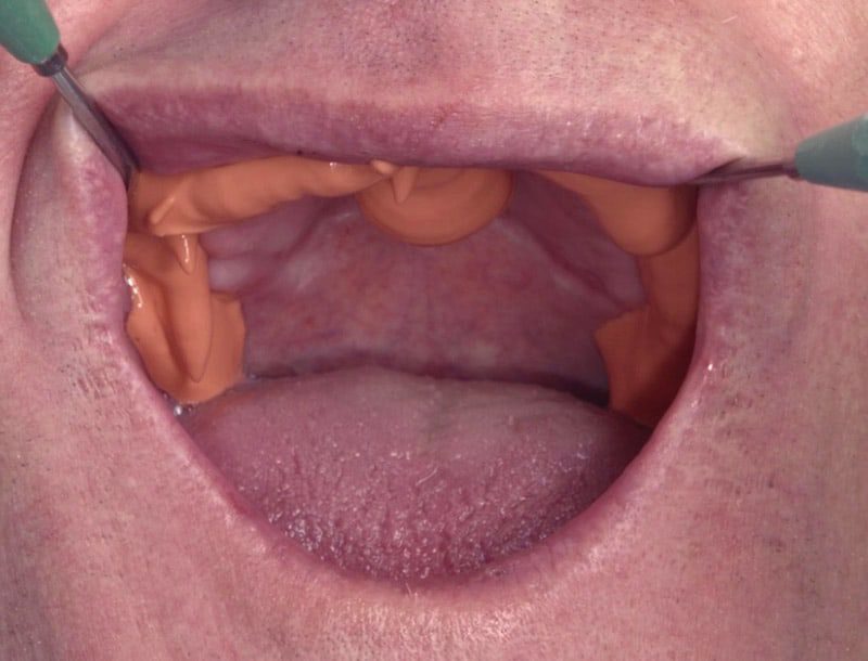 Syringe impression material for the vestibule