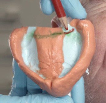 Transfer dorsal margin marking