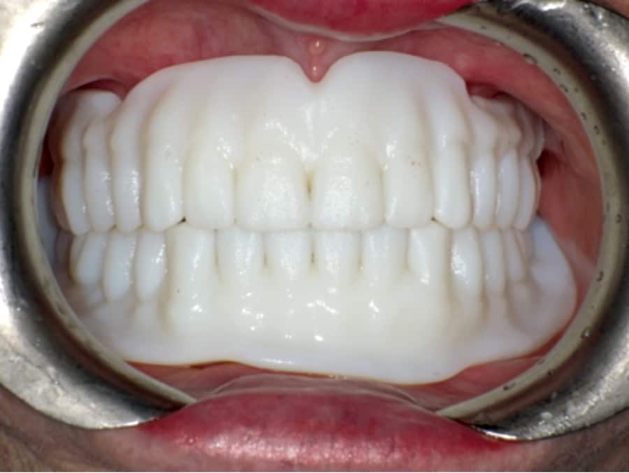 Try-in teeth setup - Fig. 14
