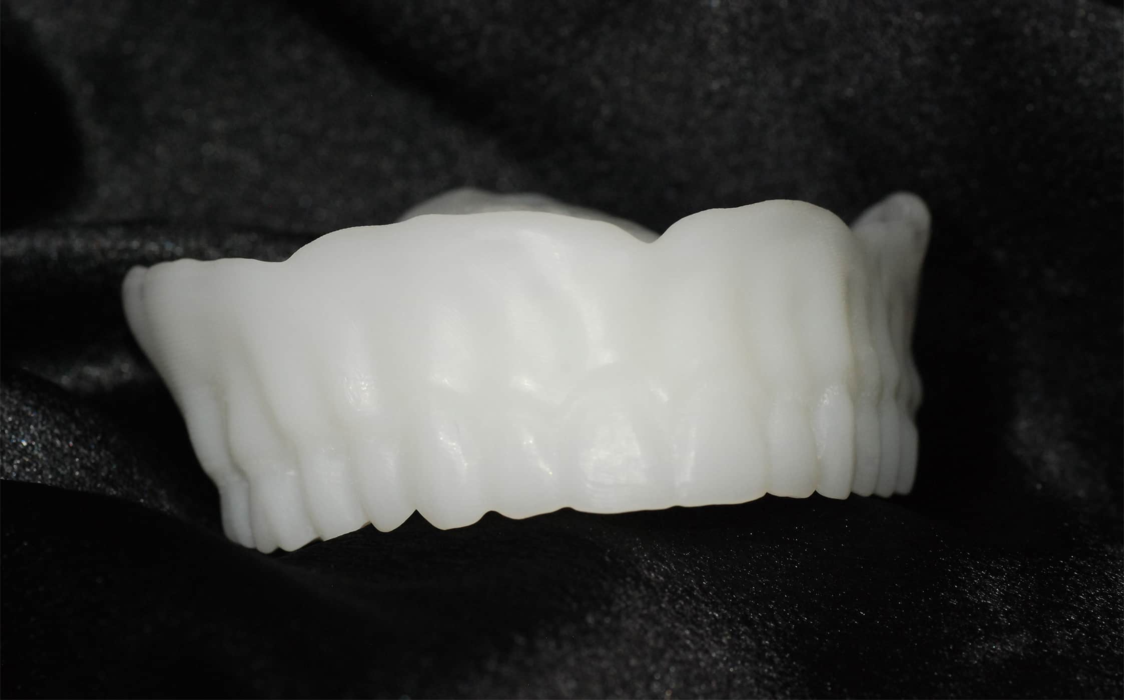 A Digital Denture Workflow Done In 3 Appointments