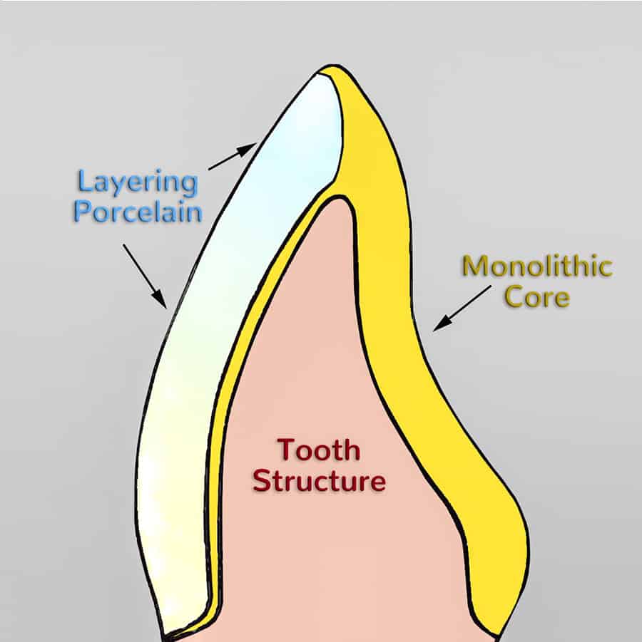 Facial layerign with incisal "Scoop" - ledge - Fig. 10