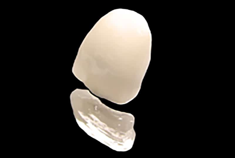 emax veneer - Figure 3