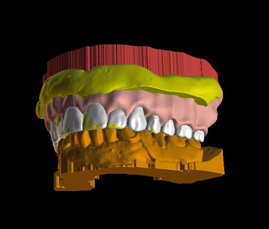Overlayed on top of old denture