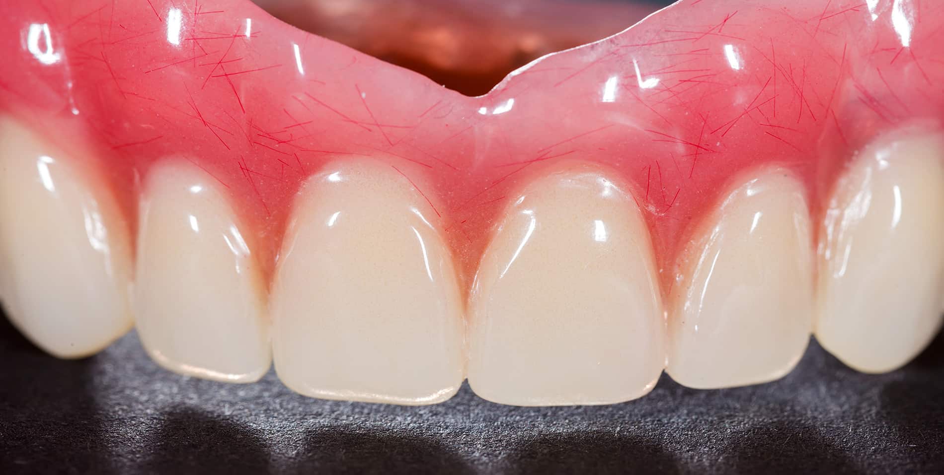 Denture Conversion and Digitally Guided Implant Surgery