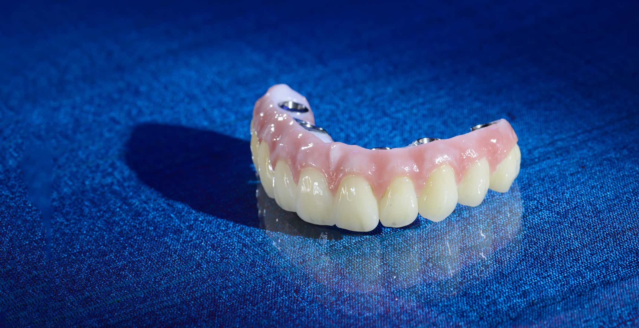 ZIRMAX M: Strength in Zirconia Implant Fixed Prosthesis