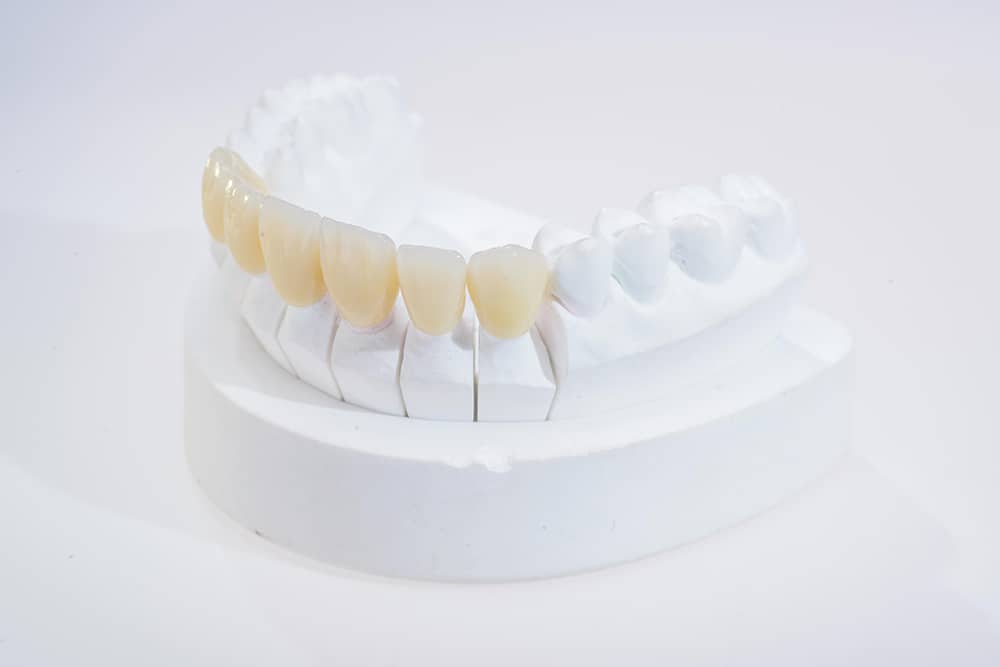 Classic Feldspathic Porcelain Veneers