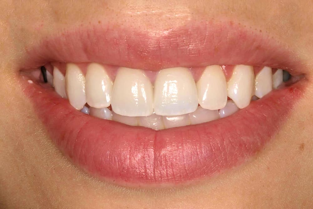 After e.Max veneers