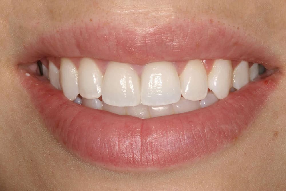 Porcelain Veneers: Prepping for Success - Burbank Dental Lab