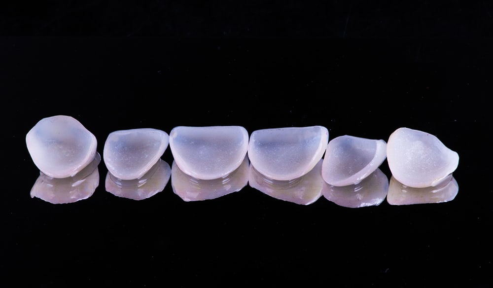 Nano® Press & Layered Veneers - Burbank Dental Lab