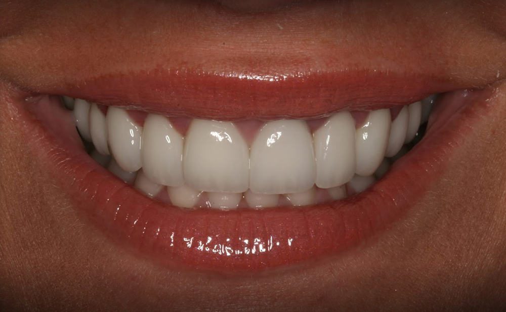Porcelain Veneers The Ultimate Smile Enhancer Burbank Dental Lab