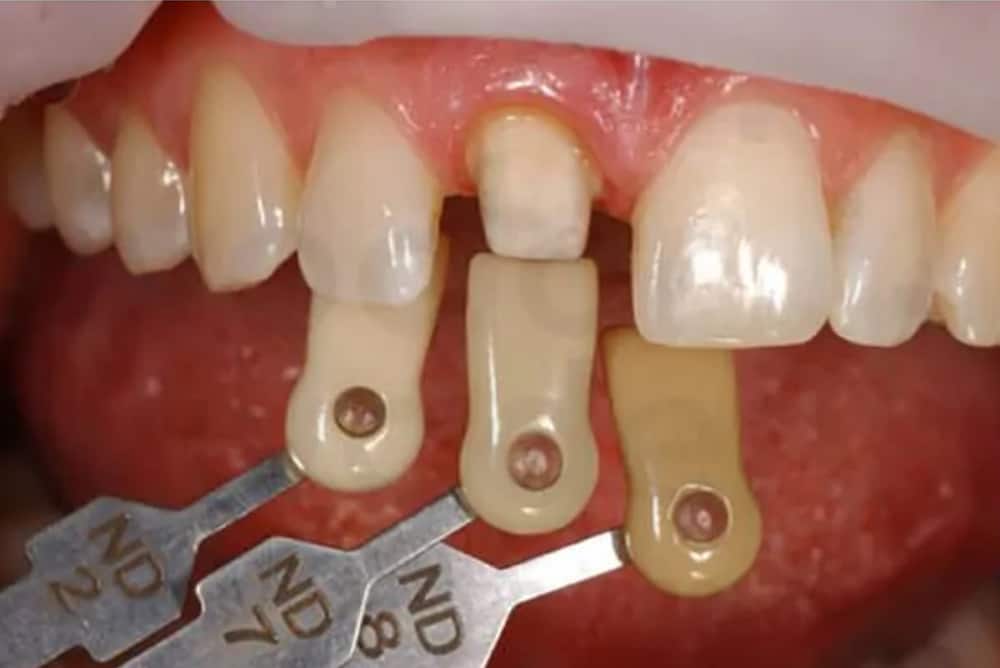 Cheek Retractors - Shade Taking - Burbank Dental Lab - CA