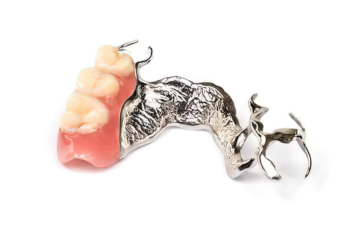 Implant-Assisted Removable Partial Dentures - Burbank Dental Lab - California Dental Lab