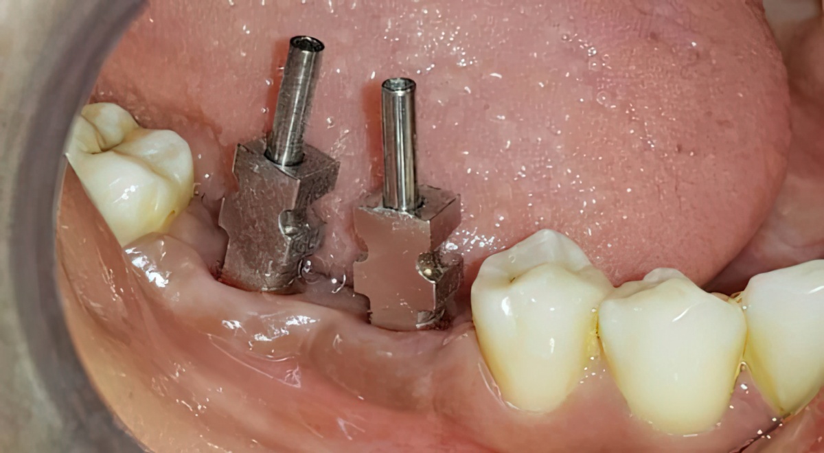 Implant-Assisted Removable Partial Denture - Burbank Dental Lab - A California Dental Lab