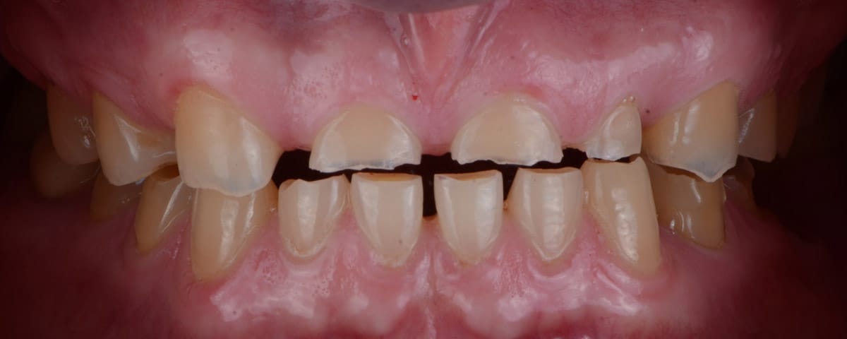 Full Mouth Reconstruction: The Pathway to Success