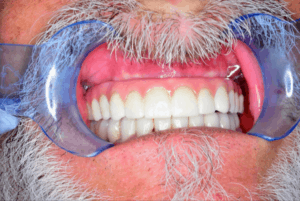 Dental patient with new teeth
