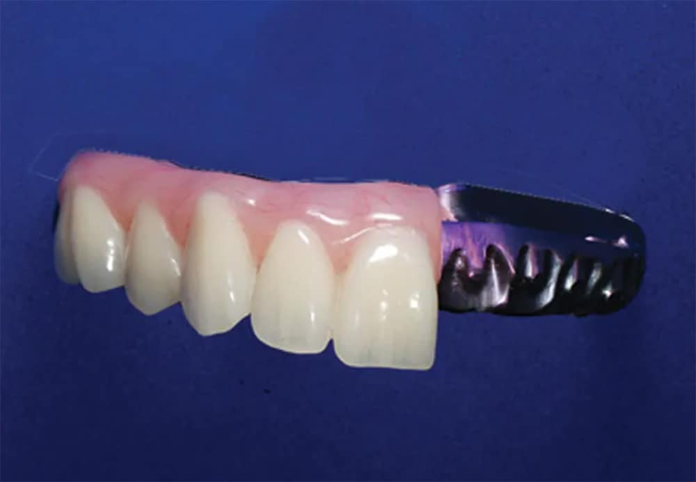 Acrylic with Titanium Substructure