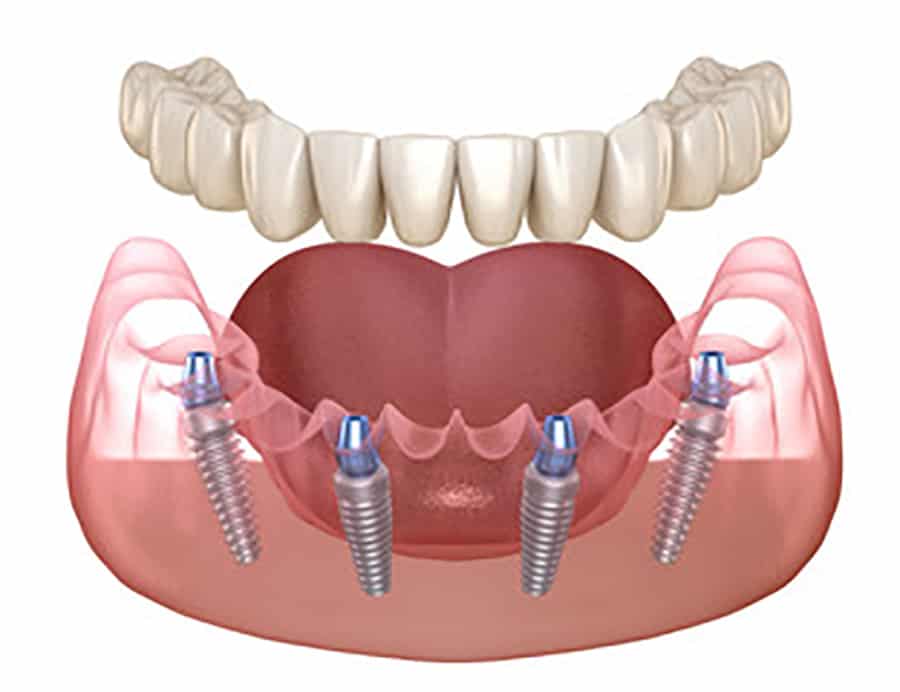 All On 4 Hybrid Implants