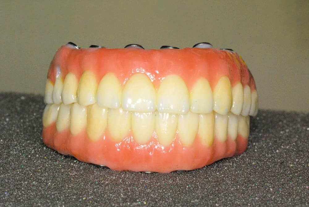 Implant-Supported Monolithic Zirconia