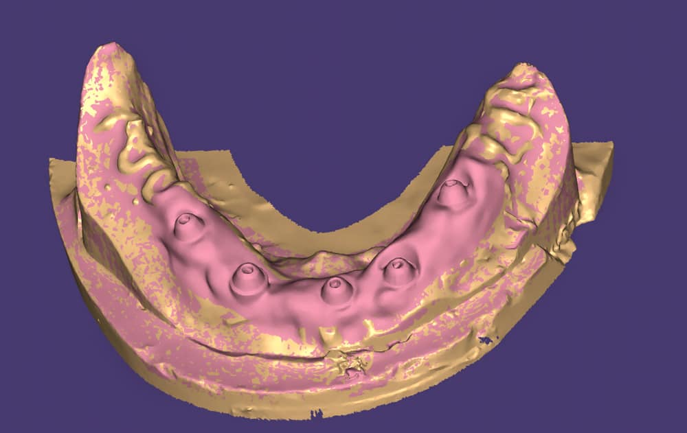 Mandibular Model - Soft tissue scanned