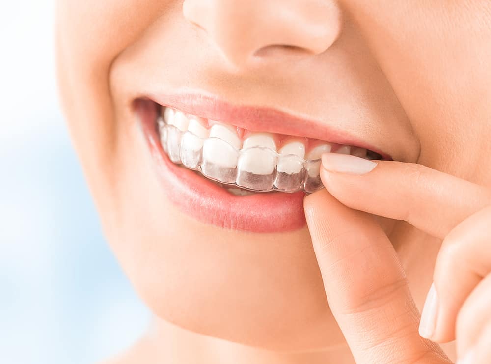 Orthodontic Tooth Movement Treatment Options with Clear Aligners