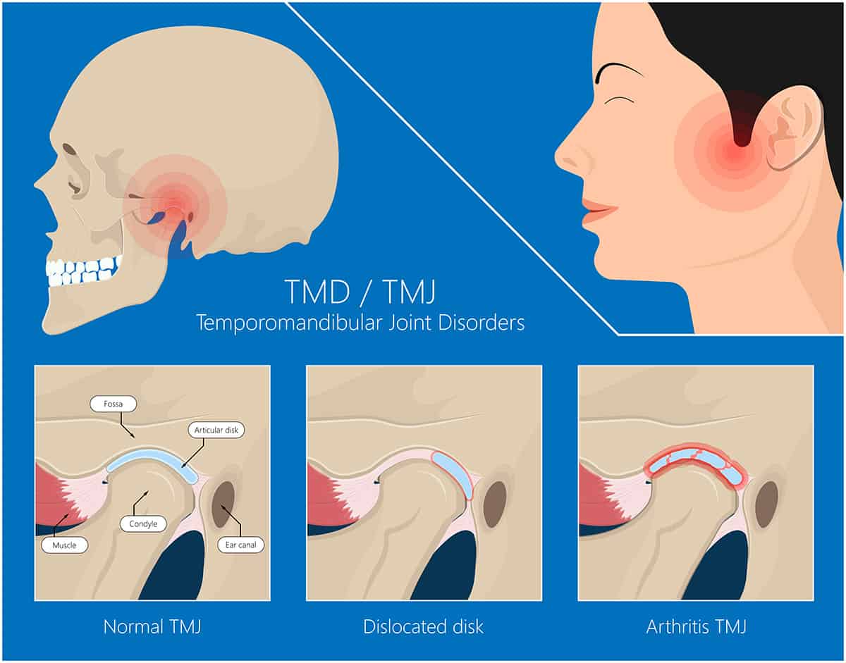 Managing TMJ symptoms