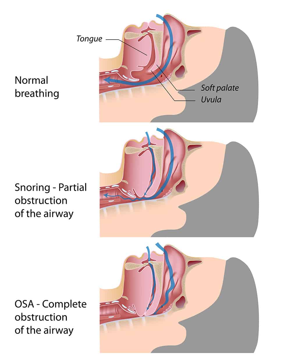 Sleep Apnea - OSA - Snoring- Breathing - Illustration