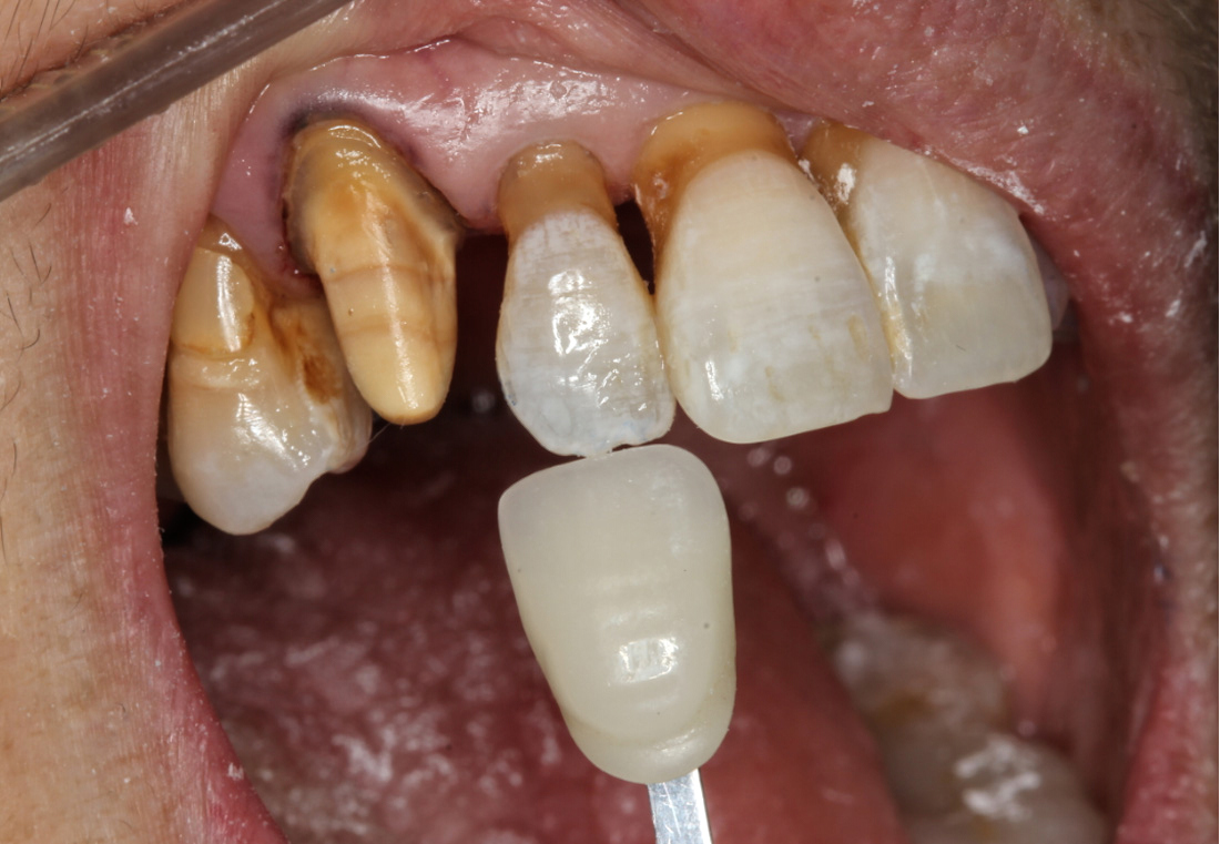 Match the crown to the patient's existing teeth