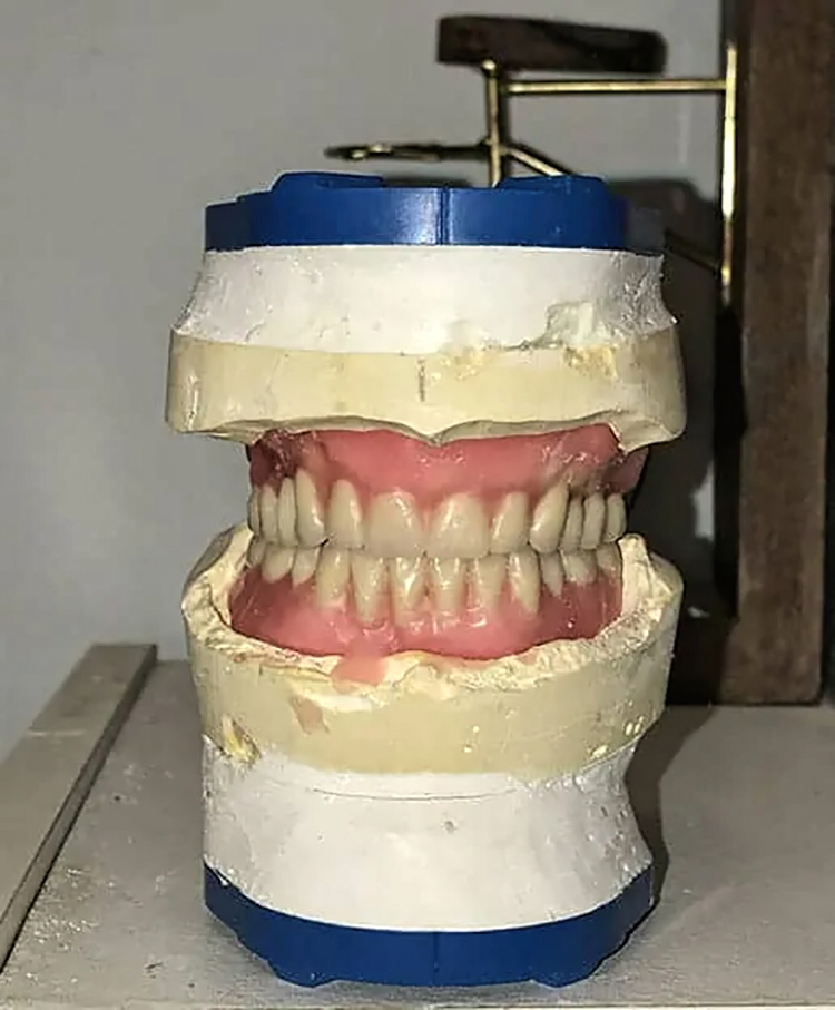 Denture Evaluation