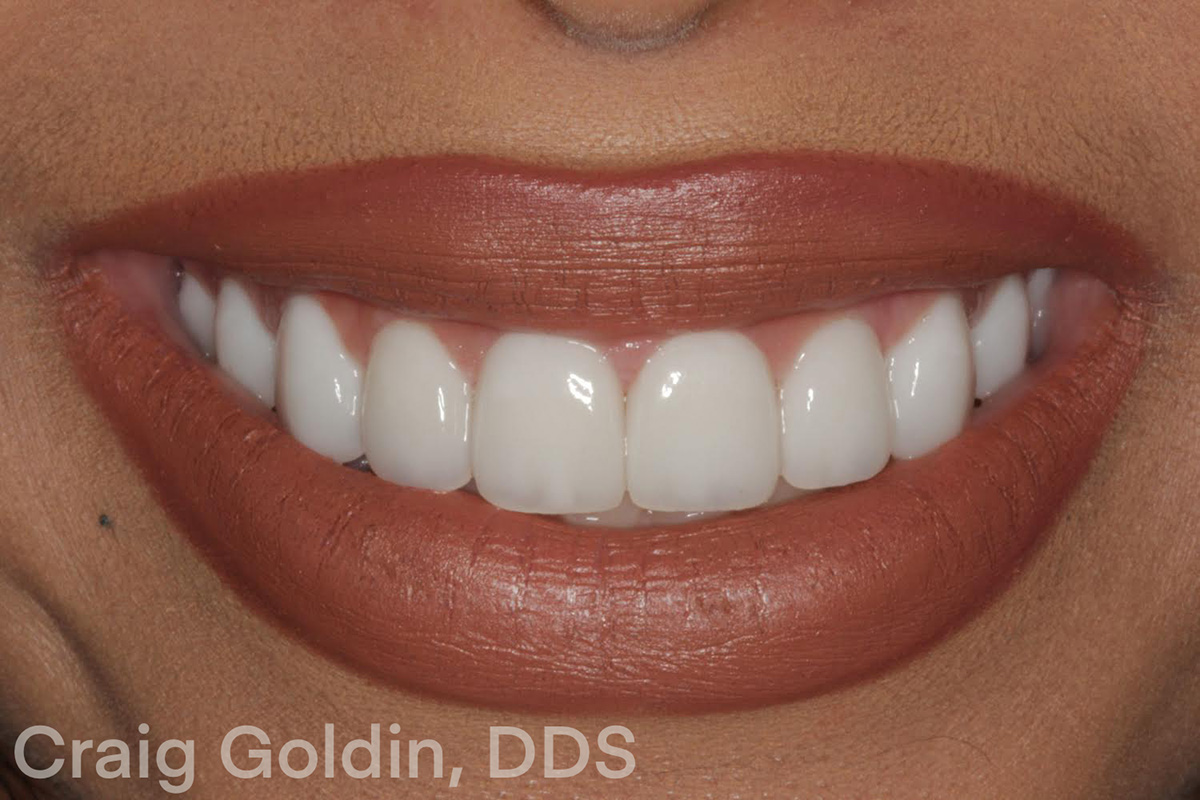 e.max layered veneers - After