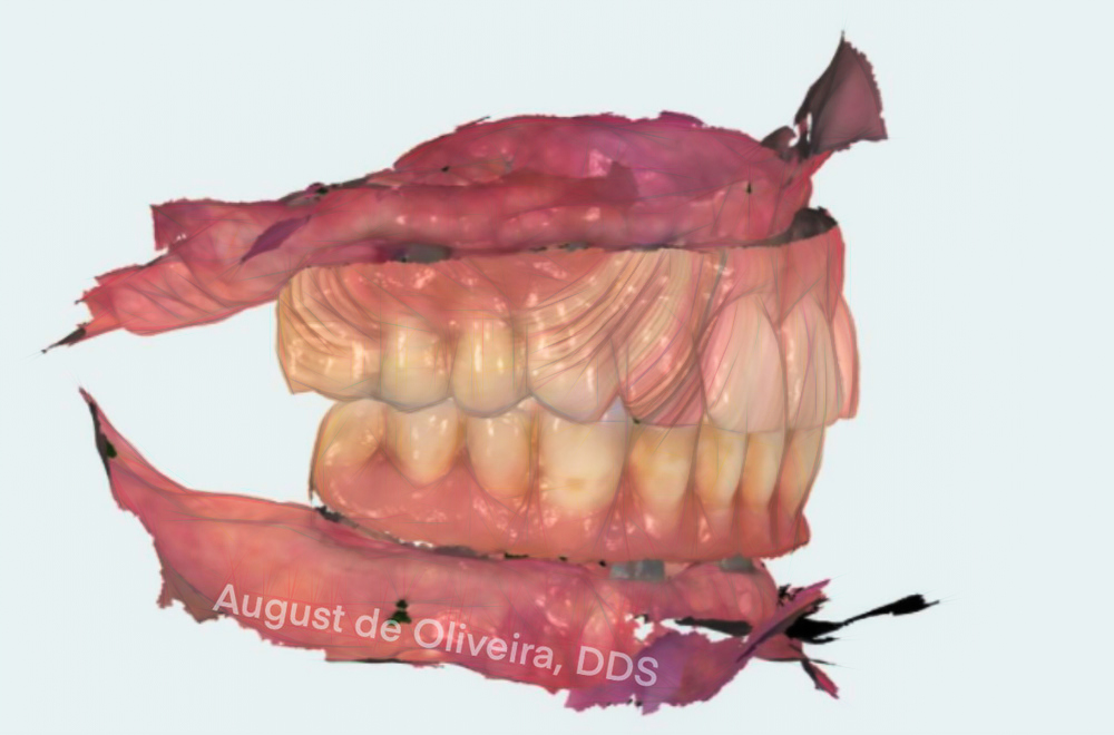 Fully Digital Workflow: Success With Multi-Unit Implant