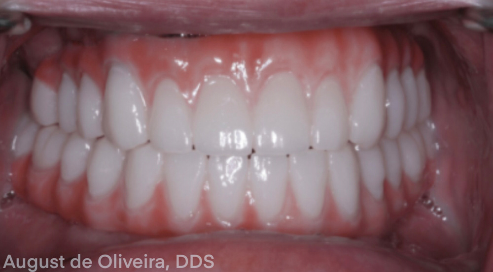 Fully Digital Workflow: Success With Multi-Unit Implant