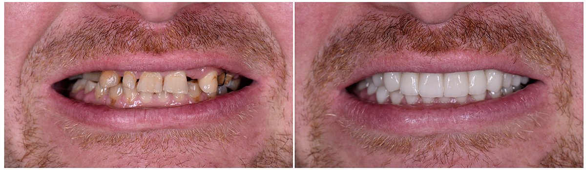 Before and After Final Restorations